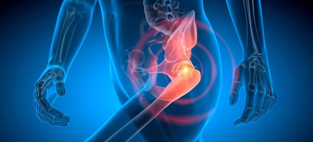 Celebrating 20 Years of Excellence in Hip Preservation at UPMC Whitfield Hospital